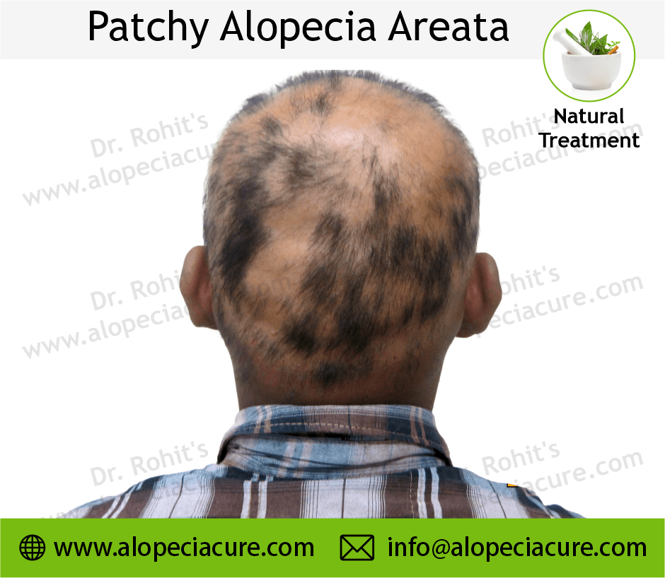 Patchy Alopecia Areata