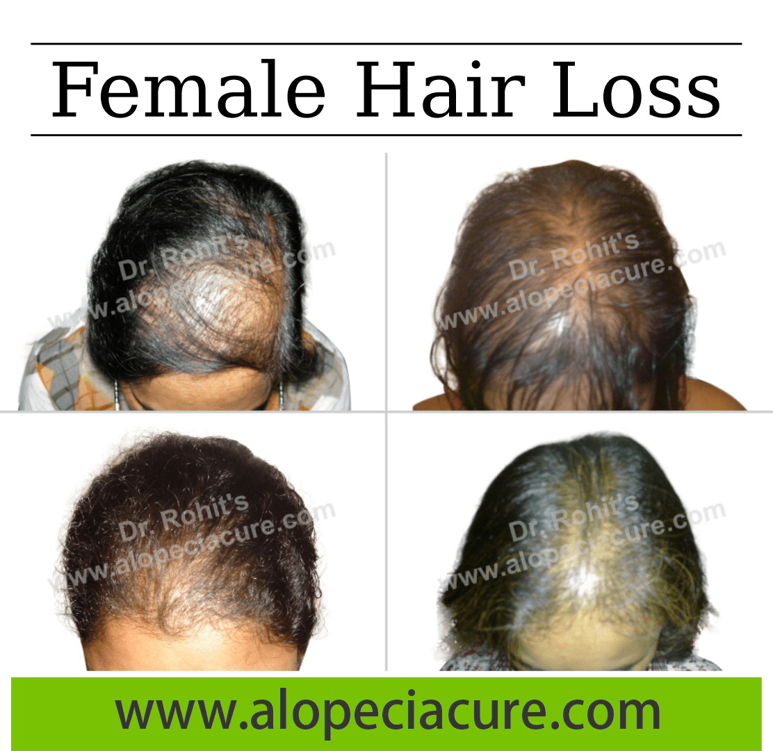 Effective Solutions For Female Hair Loss Alopecia Cure