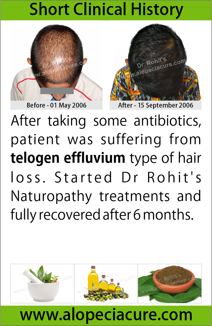 telogen effluvium treatment