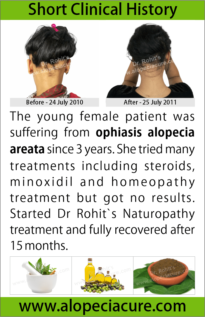 ophiasis alopecia areata treatment