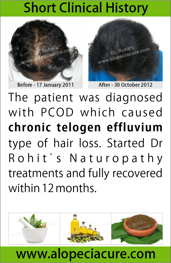 alopecia areata treatment