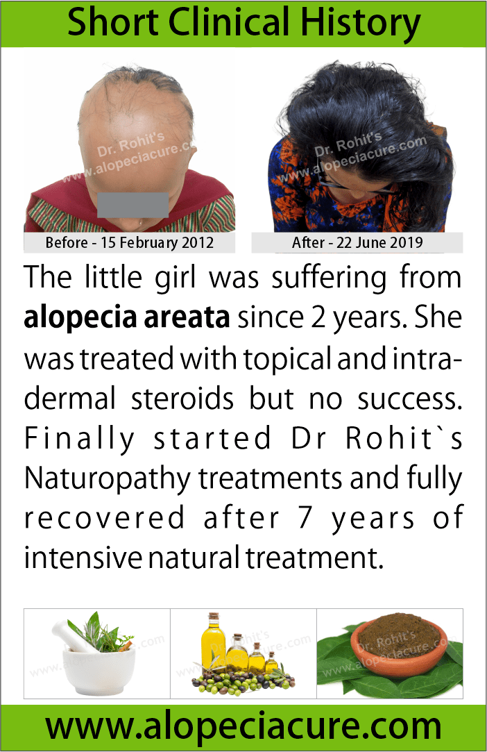  alopecia areata treatment