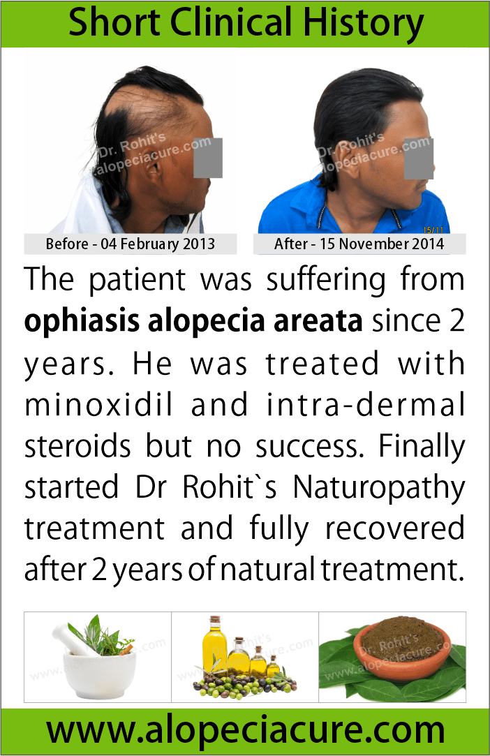 alopecia areata treatment