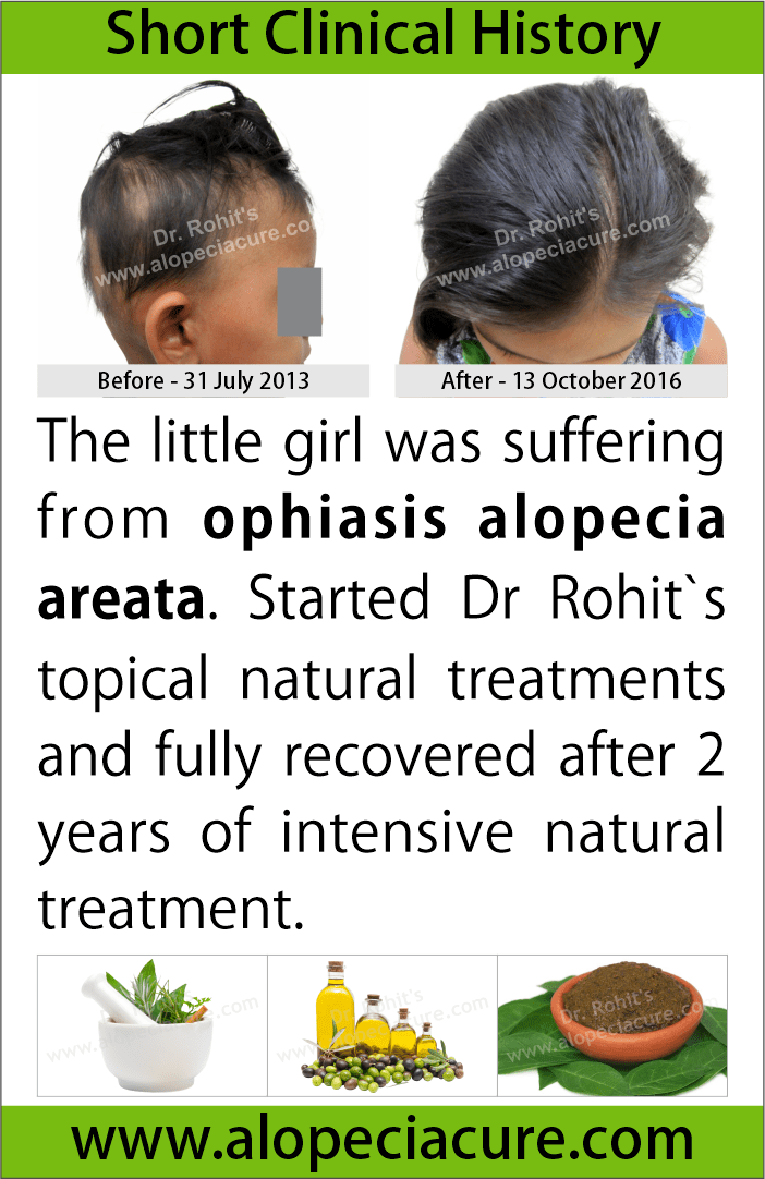 alopecia areata treatment