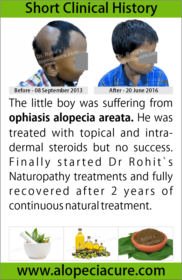 ophiasis alopecia areata treatment