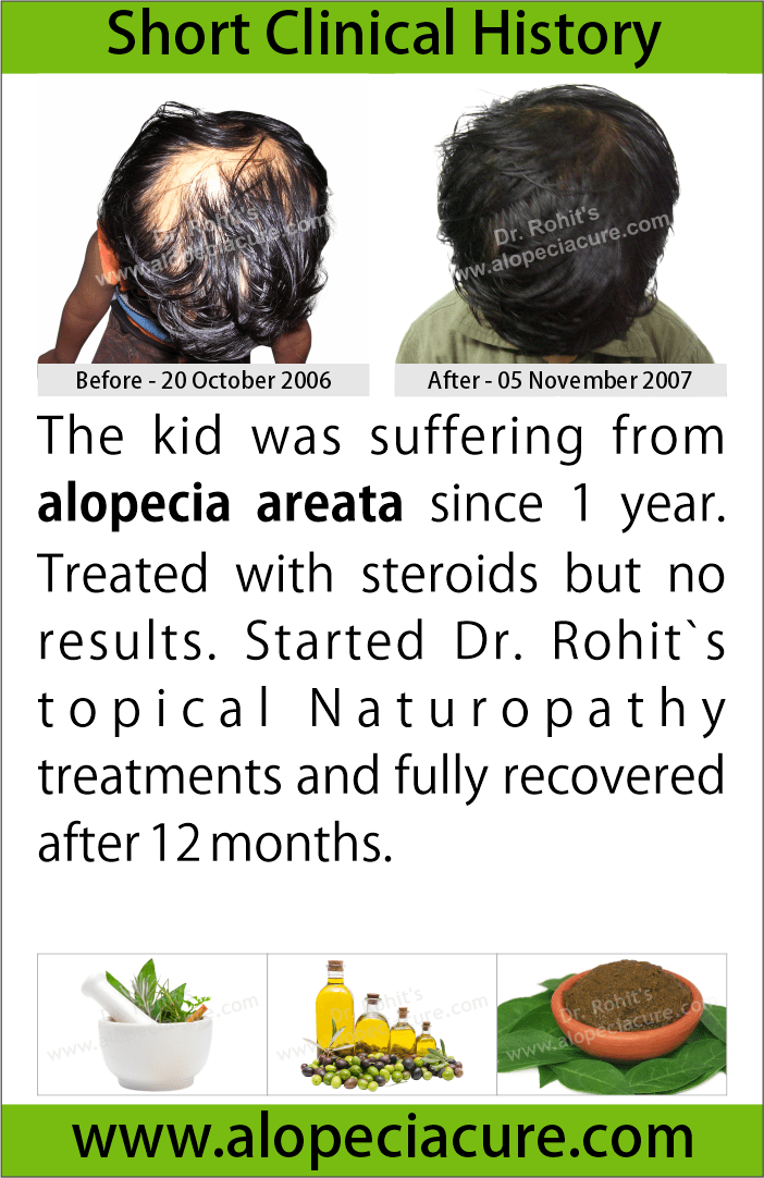 alopecia areata treatment