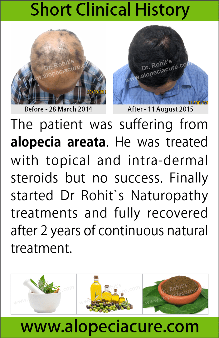 alopecia areata treatment