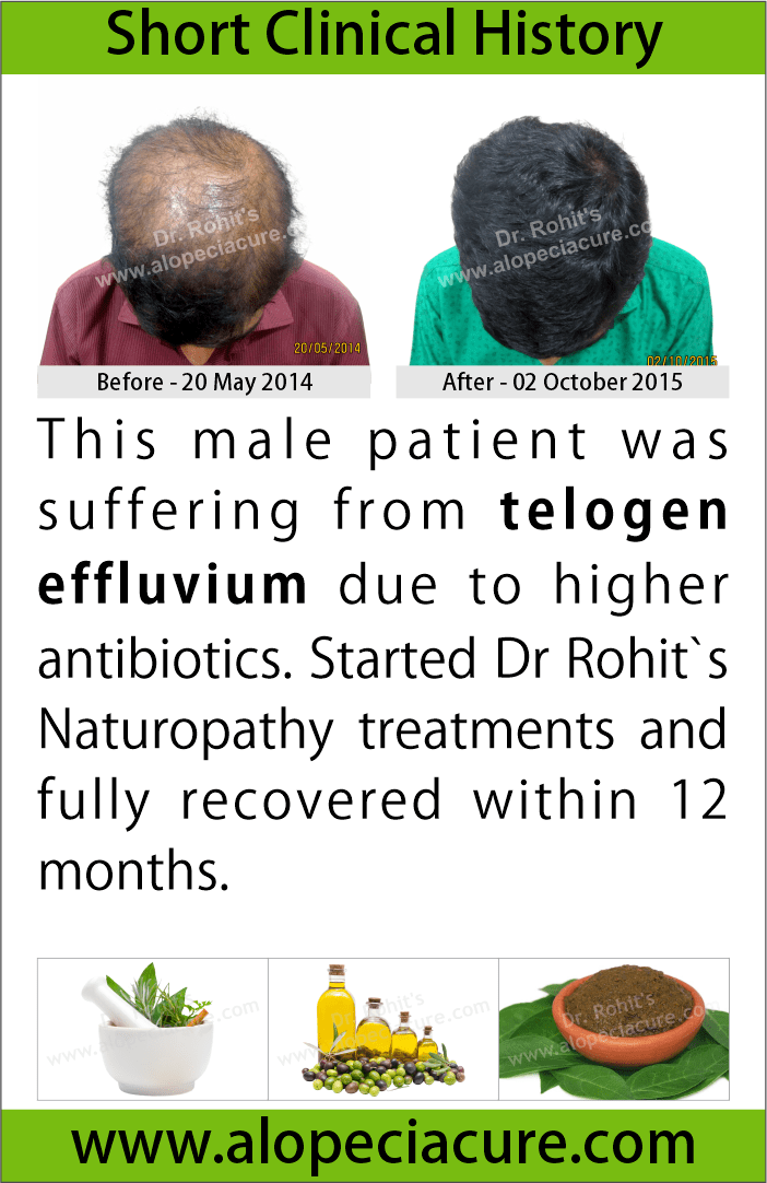   telogen effluvium treatment