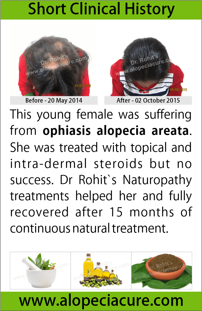 ophiasis alopecia areata treatment