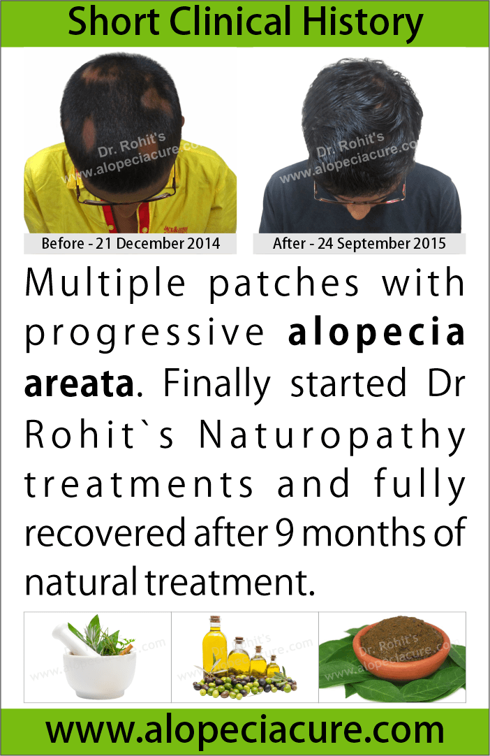 alopecia areata treatment