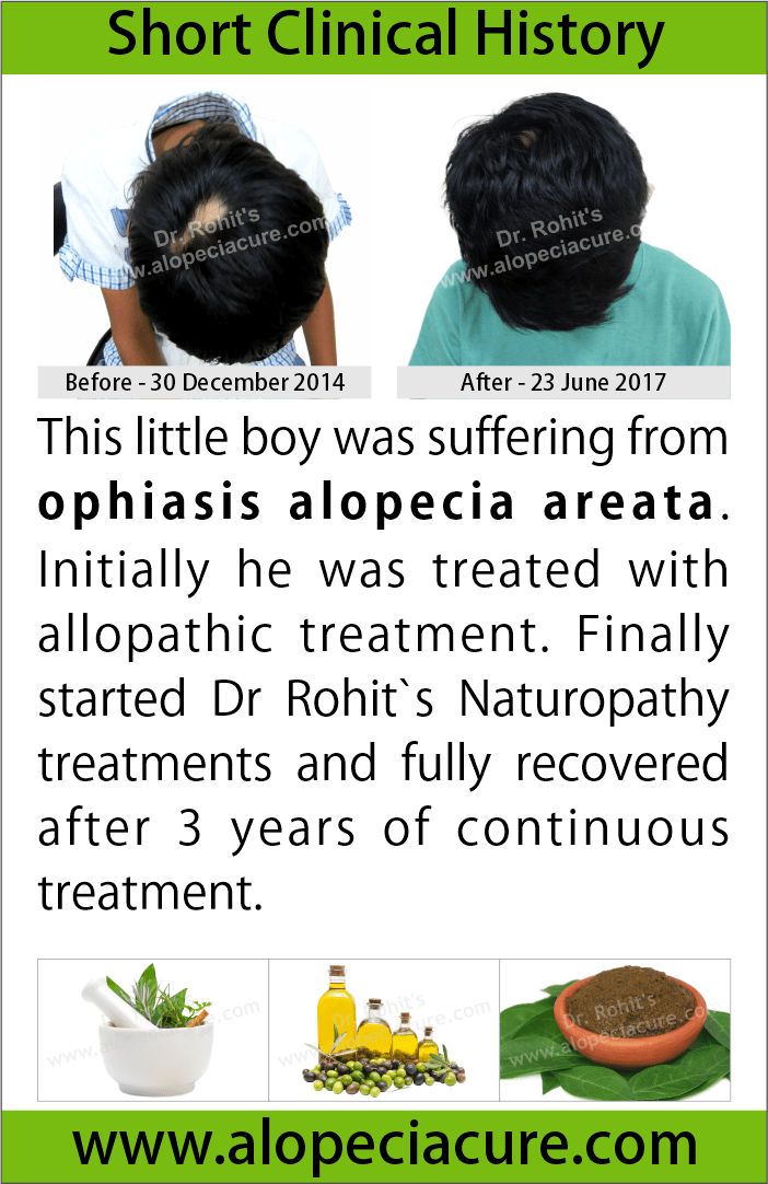 ophiasis alopecia areata treatment