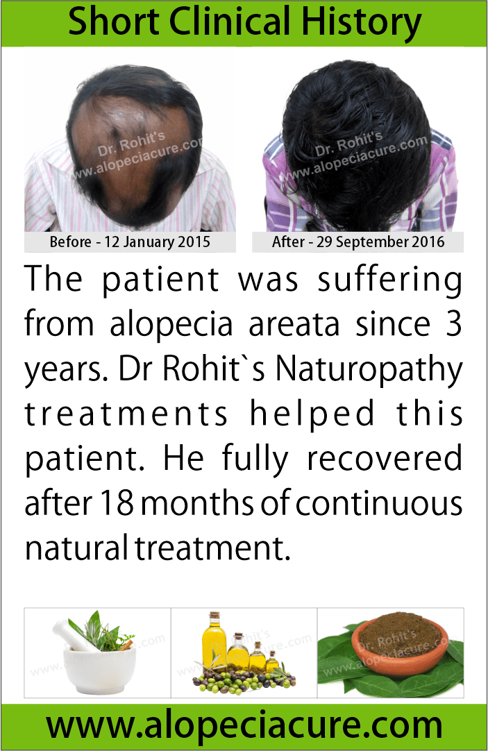 alopecia areata treatment