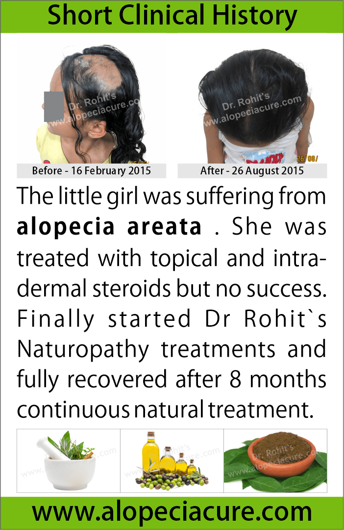 Patchy alopecia areata treatment