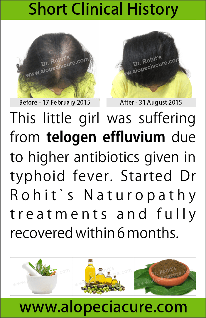   telogen effluvium treatment