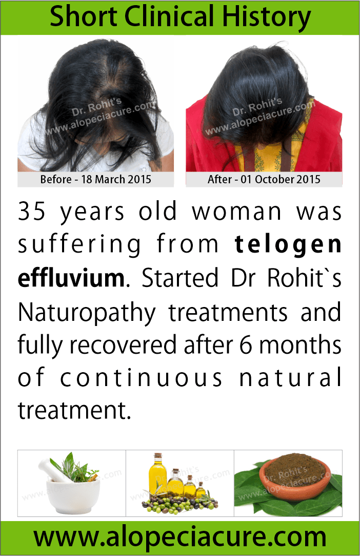 chronic telogen effluvium treatment