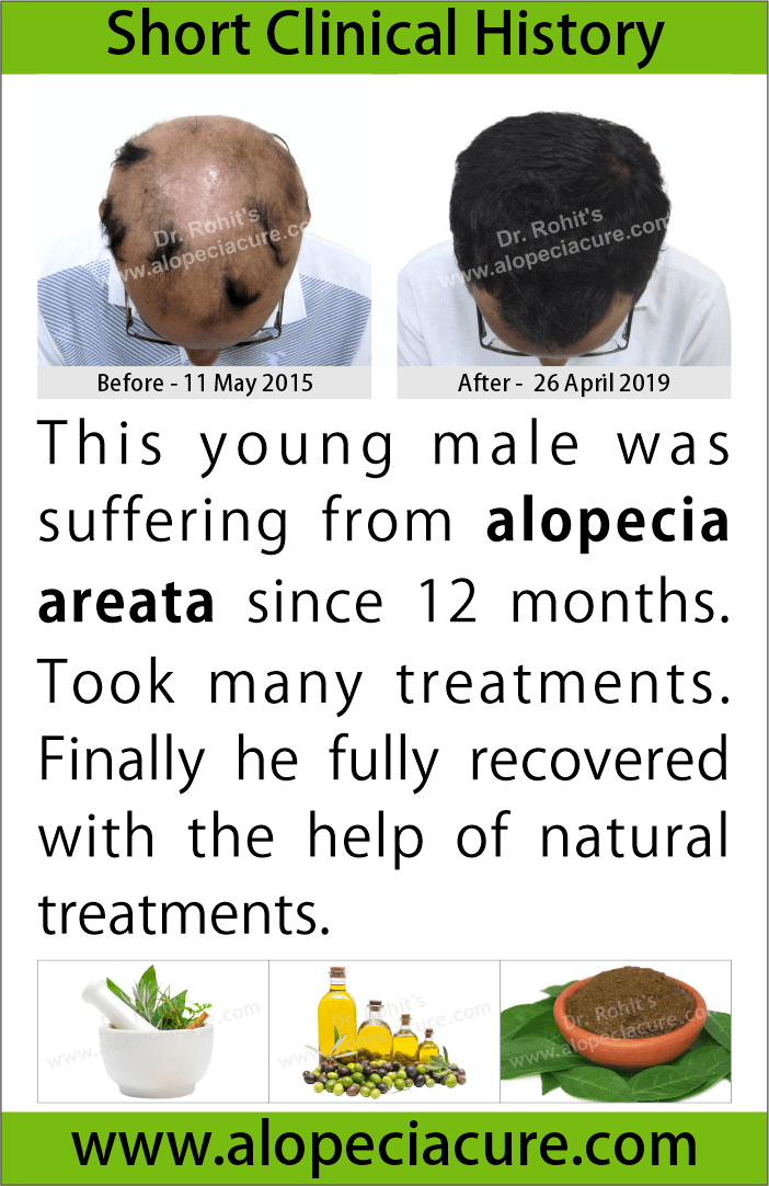 alopecia areata treatment