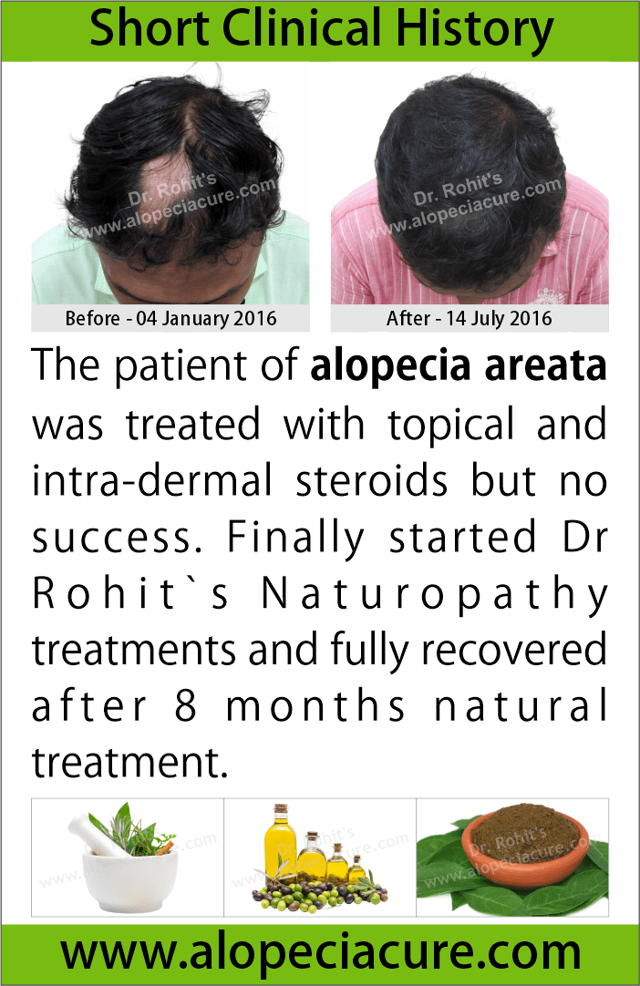 alopecia areata treatment