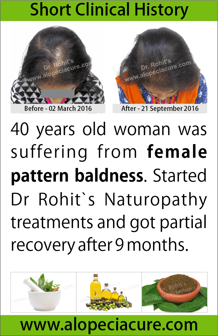 ophiasis alopecia areata treatment