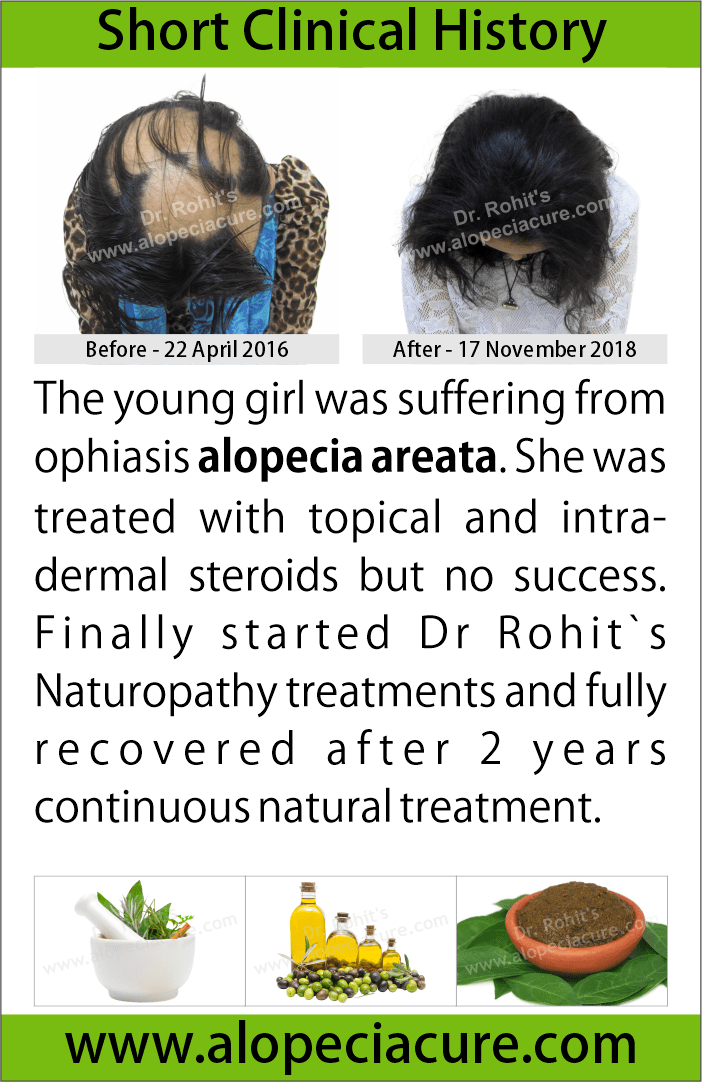 ophiasis alopecia areata treatment