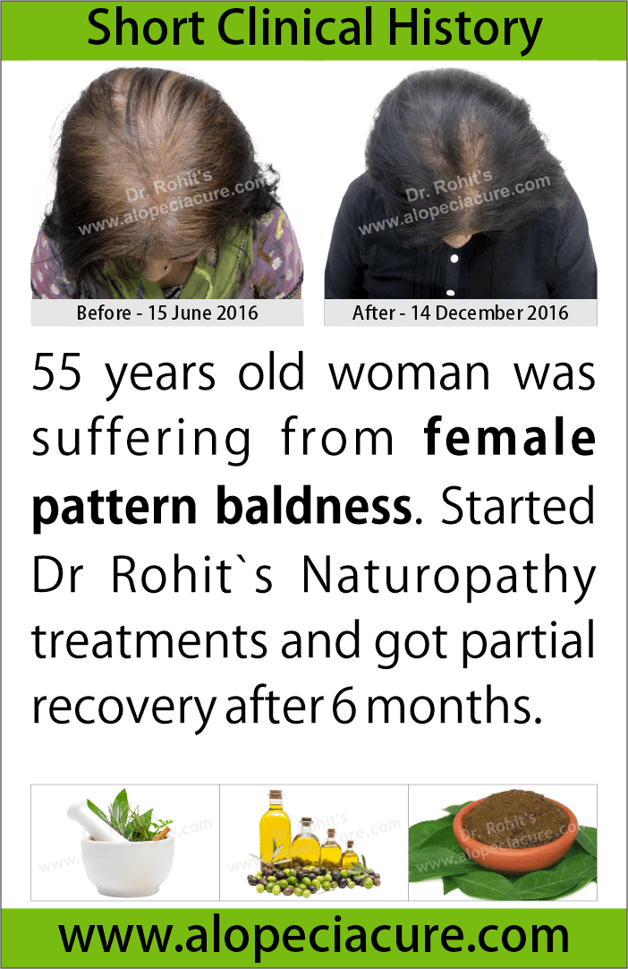 Female Pattern Baldness treatment