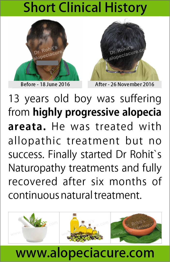 prograssive alopecia areata treatment