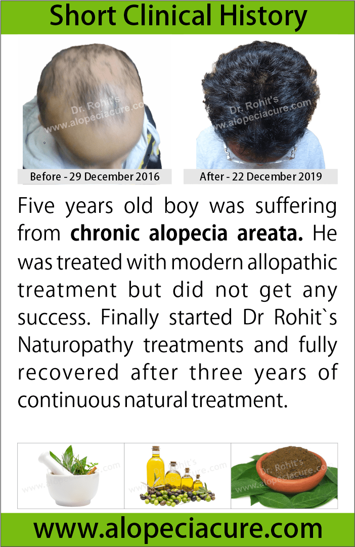 chronic alopecia areata treatment