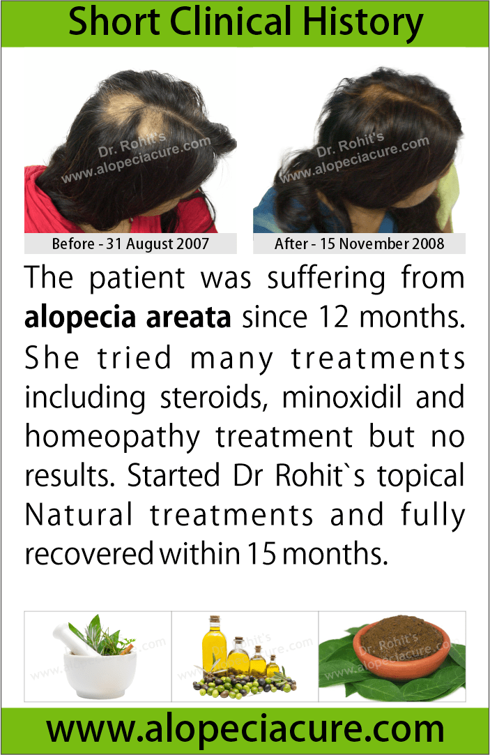 alopecia areata treatment