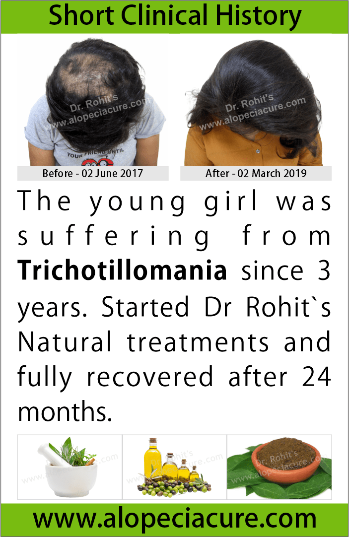 trichotillomania treatment