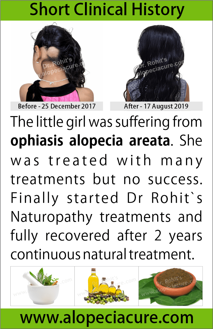 ophiasis alopecia areata treatment