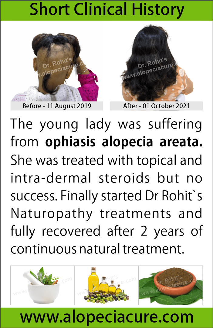 ophiasis alopecia areata treatment