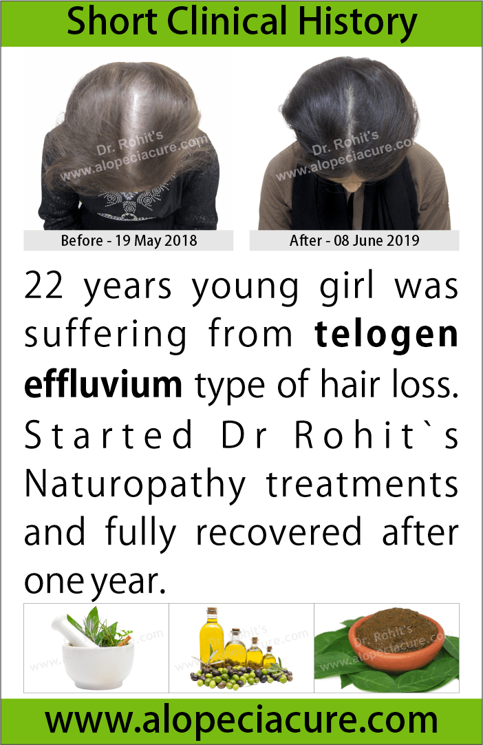 telogen effluvium treatment