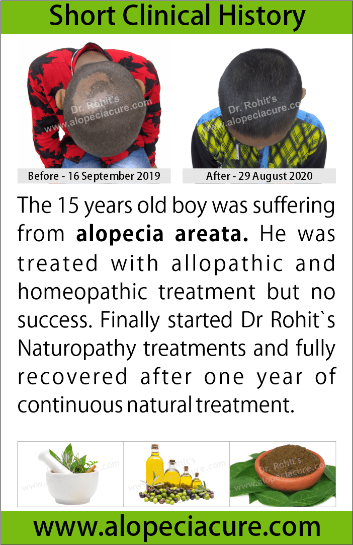 alopecia areata treatment