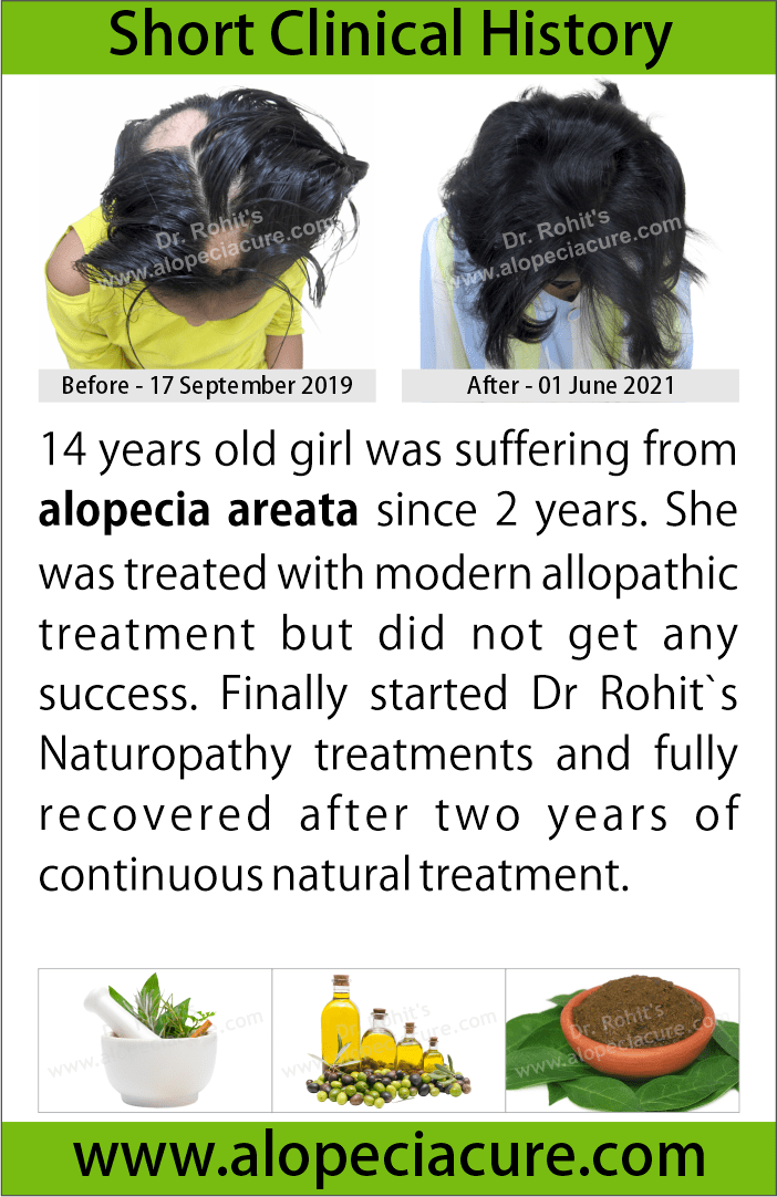 alopecia areata treatment