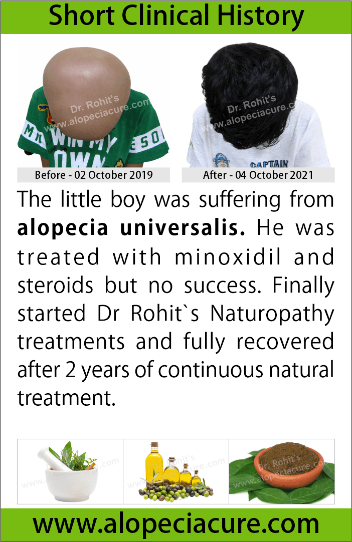 alopecia universalis treatment