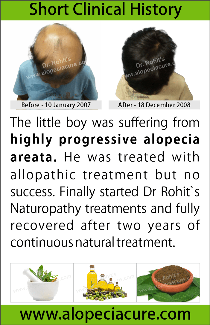 alopecia areata treatment