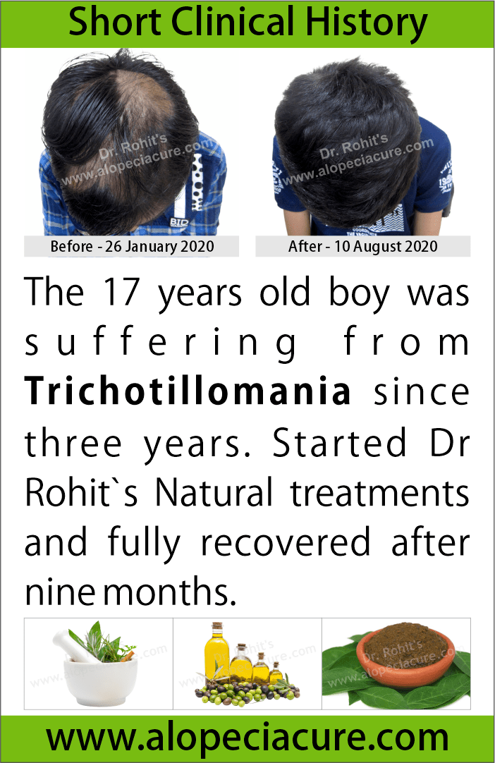 trichotillomania treatment