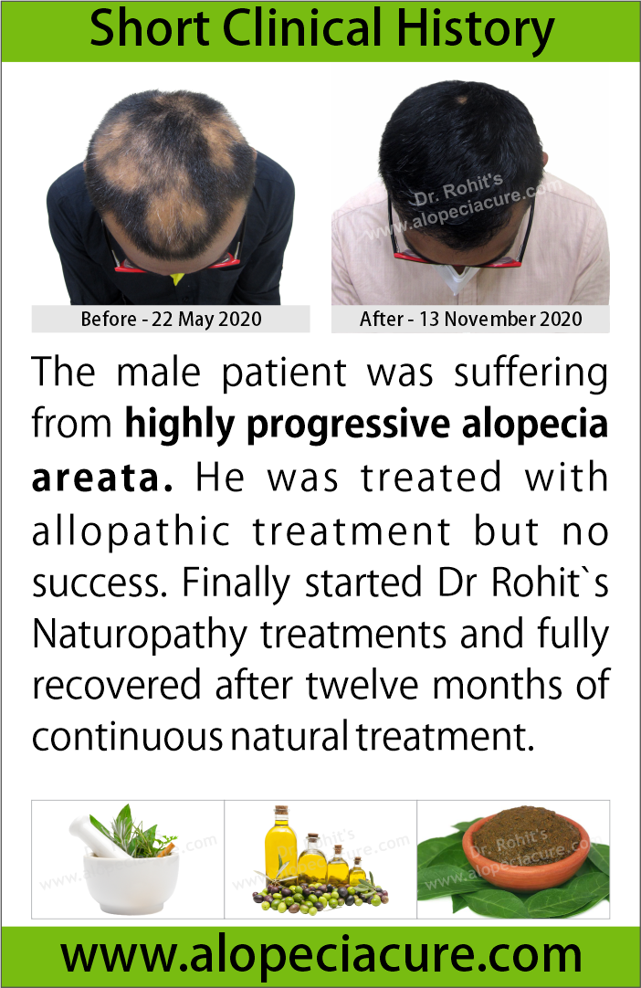 prograssive alopecia areata treatment