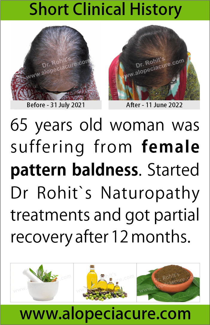 female hair loss treatment