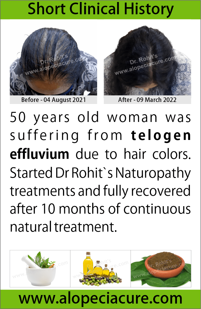 telogen effluvium treatment