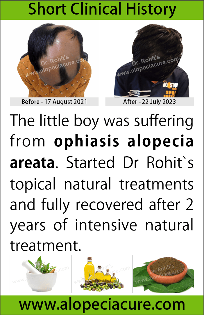 ophiasis alopecia areata treatment