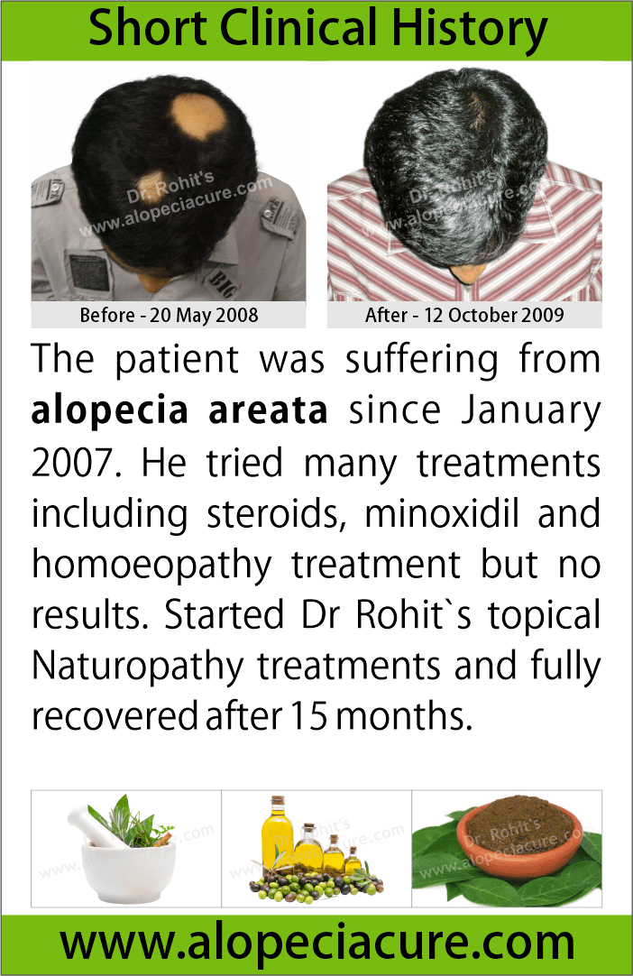 alopecia areata treatment