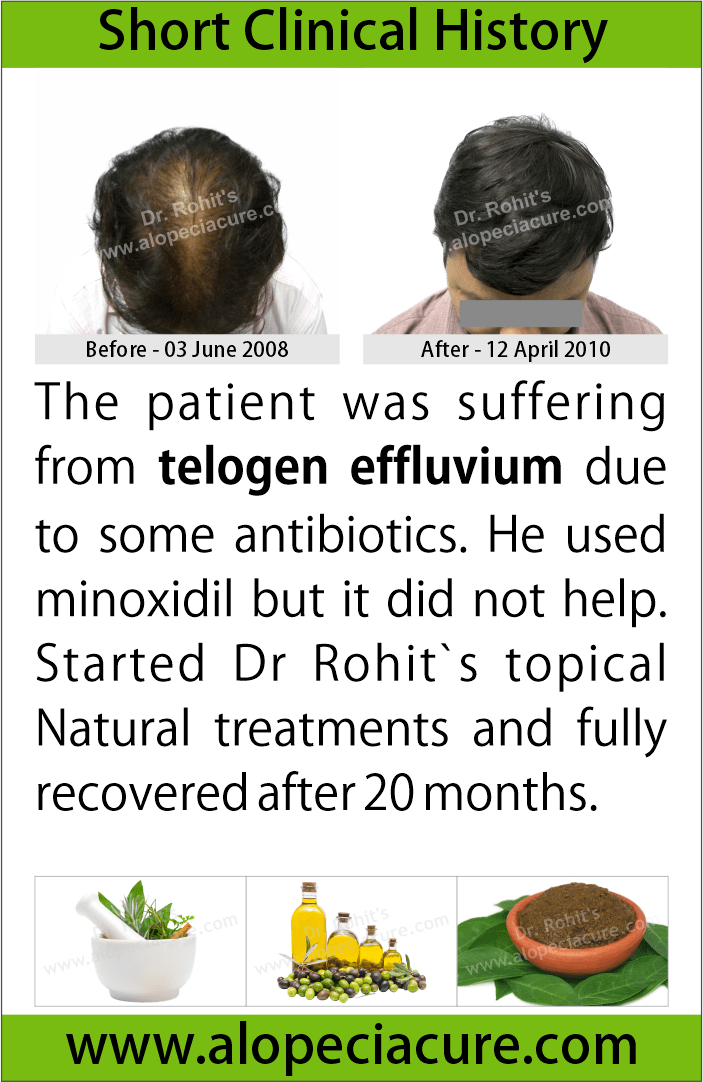   telogen effluvium treatment