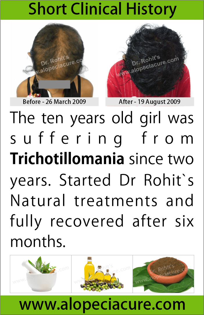 trichotillomania treatment