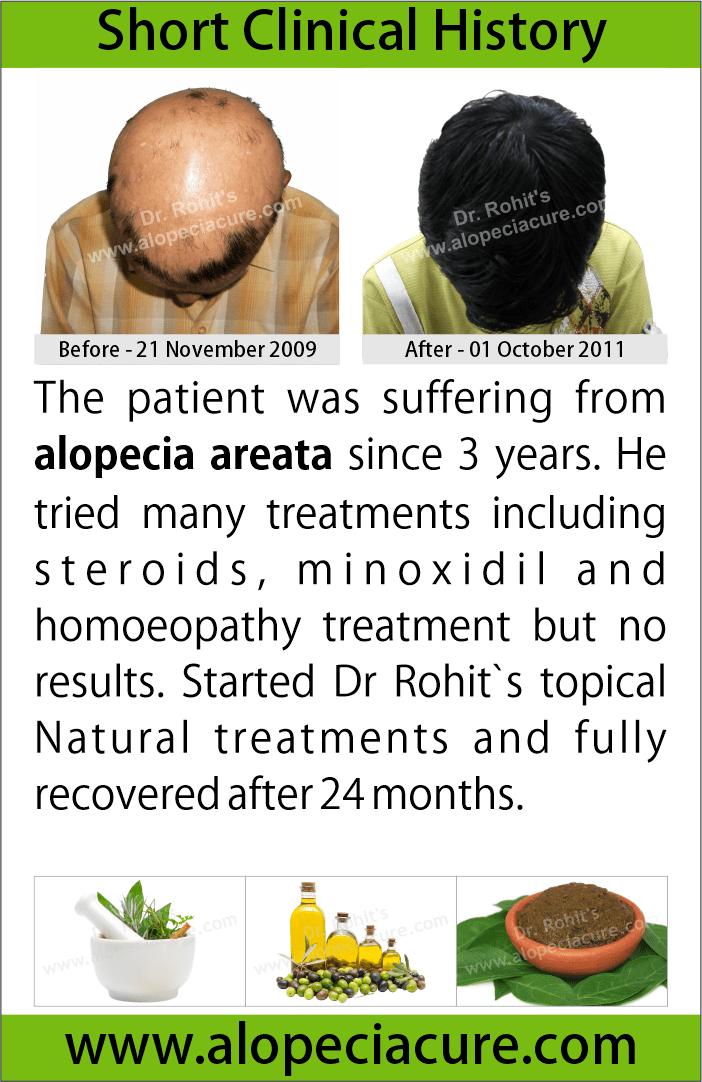 alopecia areata treatment