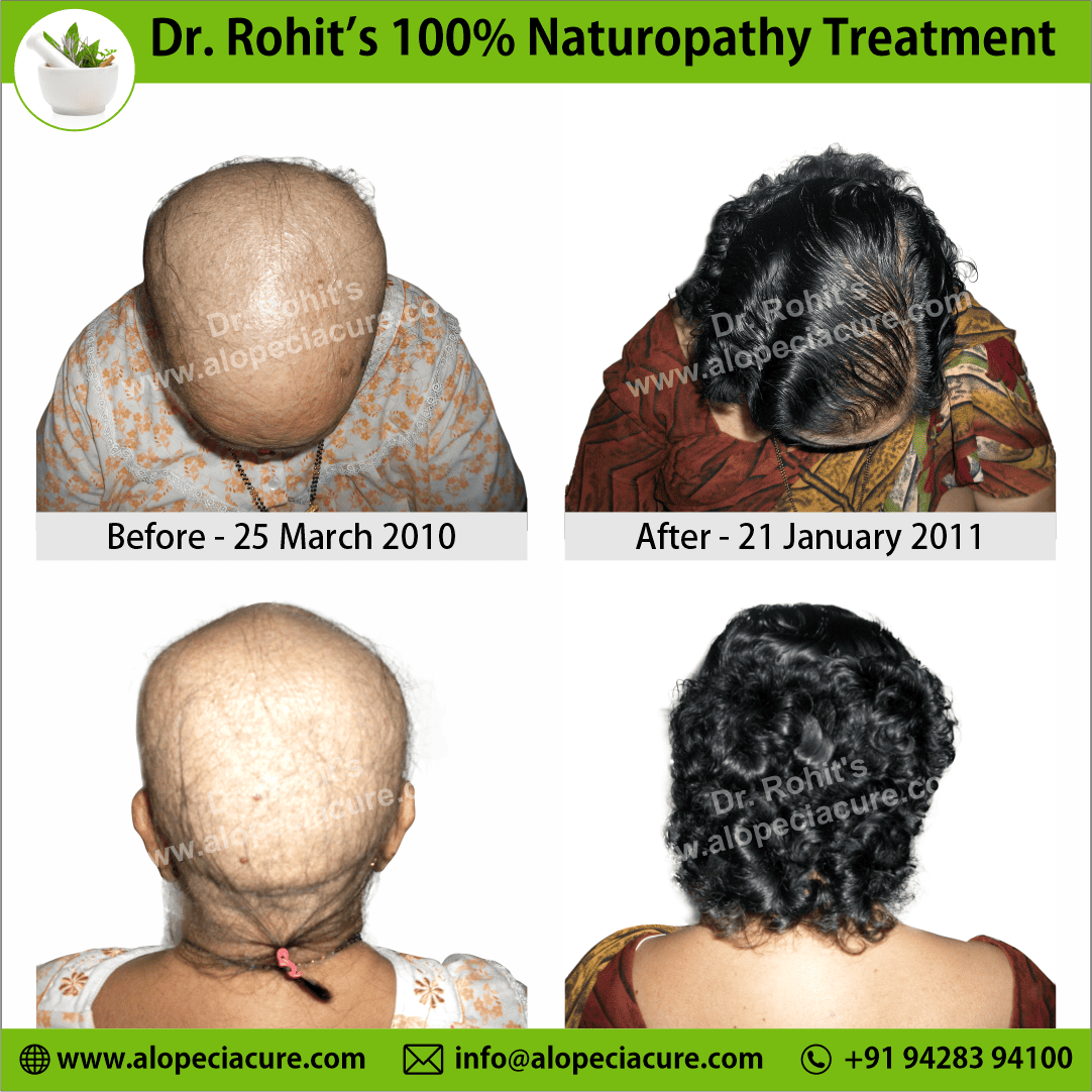 Chemotherapy hair loss