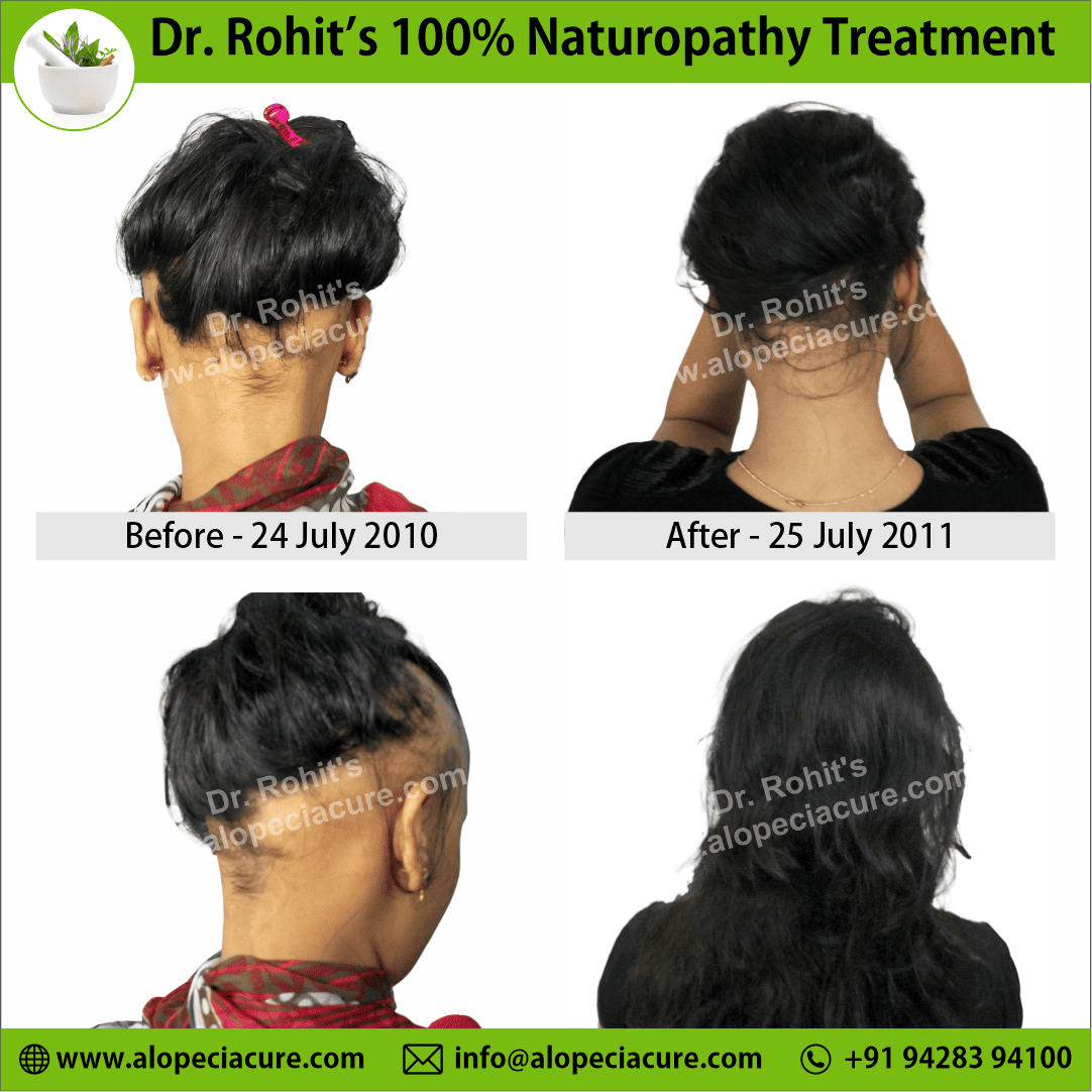 ophiasis alopecia areata treatment