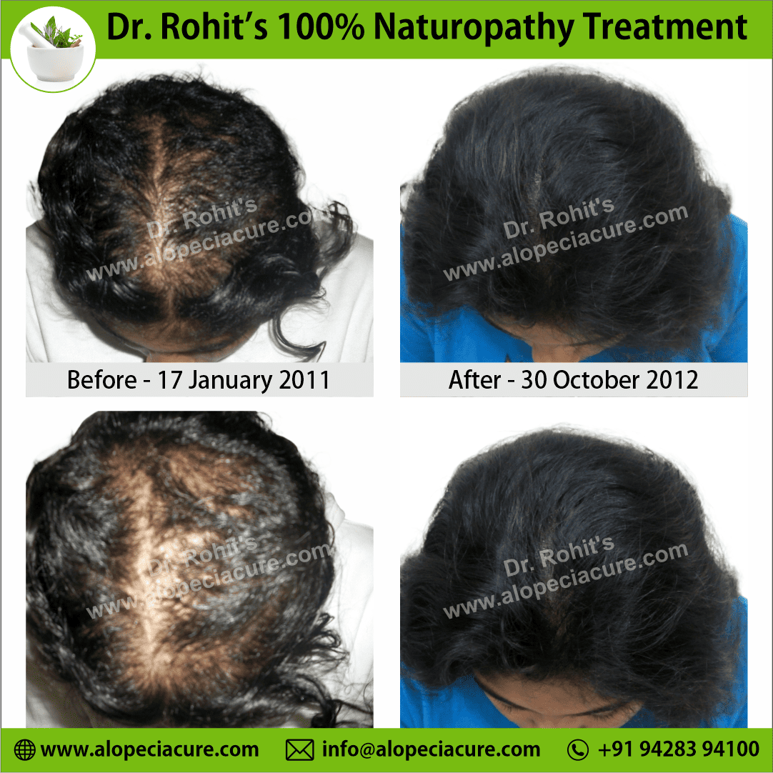 alopecia areata treatment