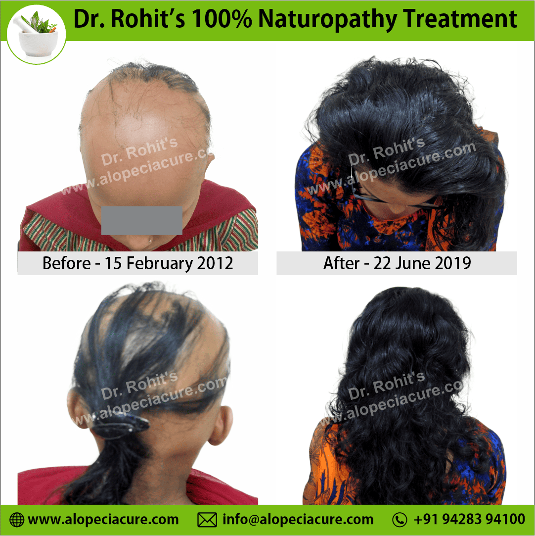  alopecia areata treatment