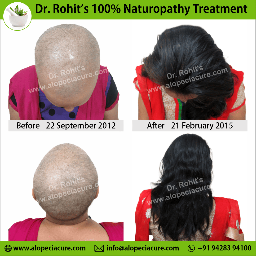 Chemotherapy hair loss