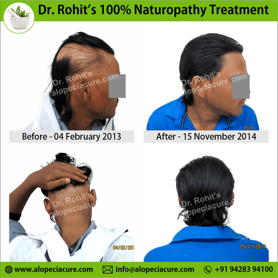 alopecia areata treatment